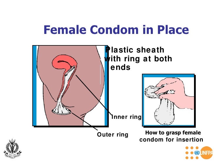 menstruation female condom Menstruation female condom